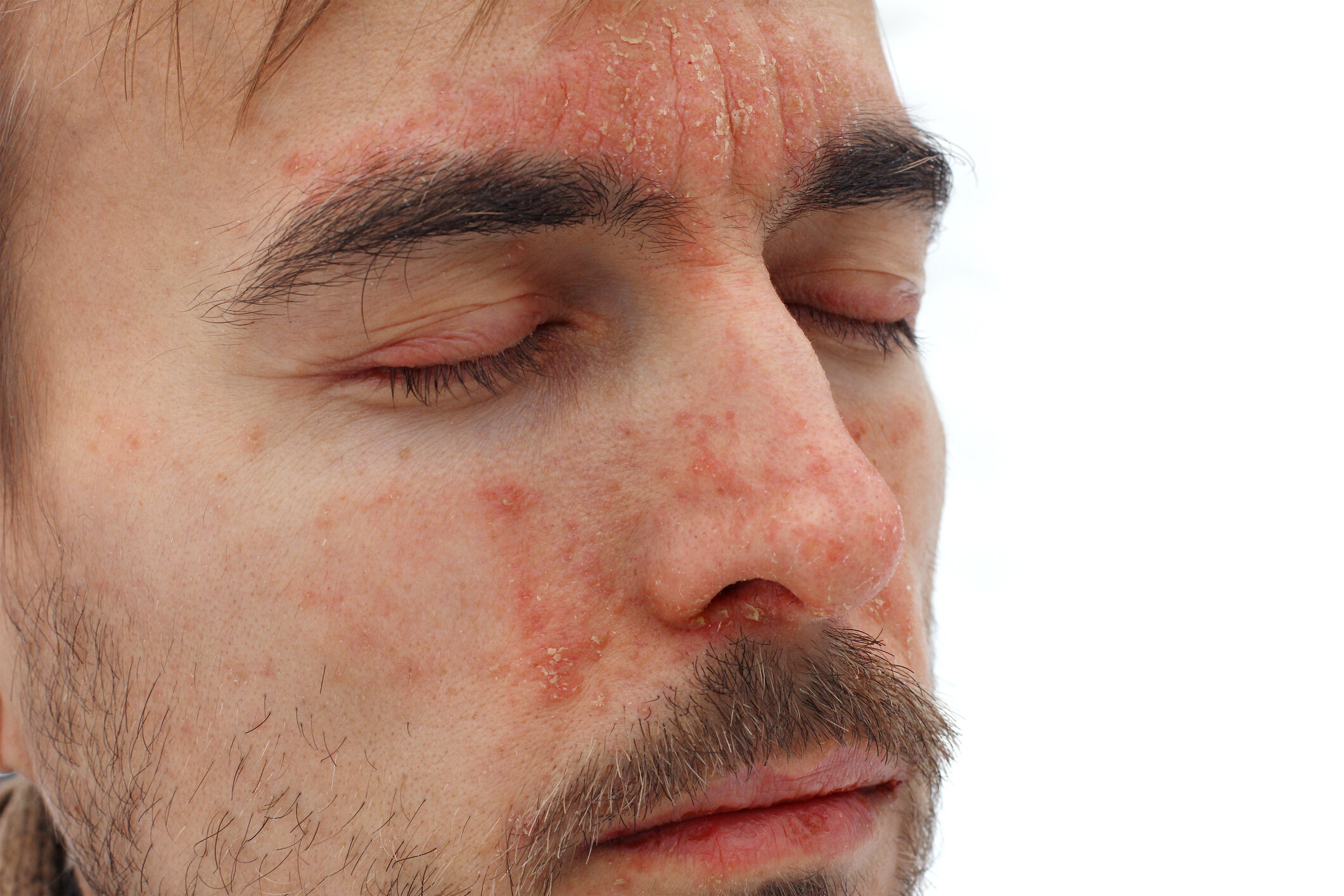 vörös foltok az arcon seborrheás dermatitis